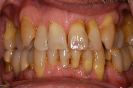 Teeth Whitening in Morgan Hill, CA | Jeffrey S. Miller DDS