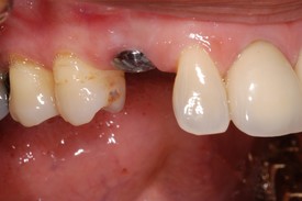 Dental Implants in Morgan Hill, CA | Jeffrey S. Miller DDS